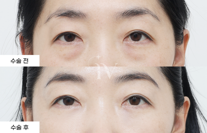 눈밑지방재배치