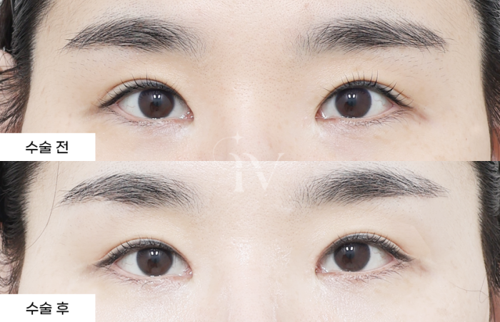 절개쌍꺼풀 (타병원 눈재수술)