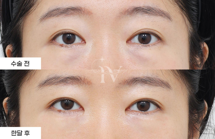 눈밑지방재배치