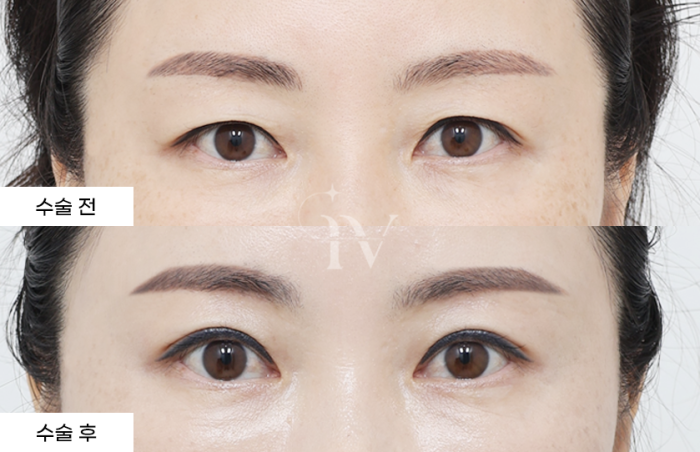 눈썹하거상, 매몰 쌍꺼풀