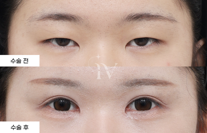 절개 쌍꺼풀, 눈매교정, 앞트임