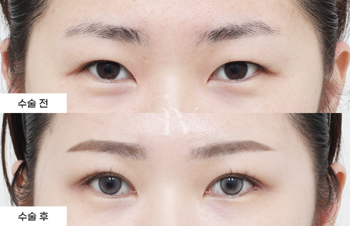절개쌍꺼풀, 듀얼트임, 뷰트임 (타병원 눈재수술)