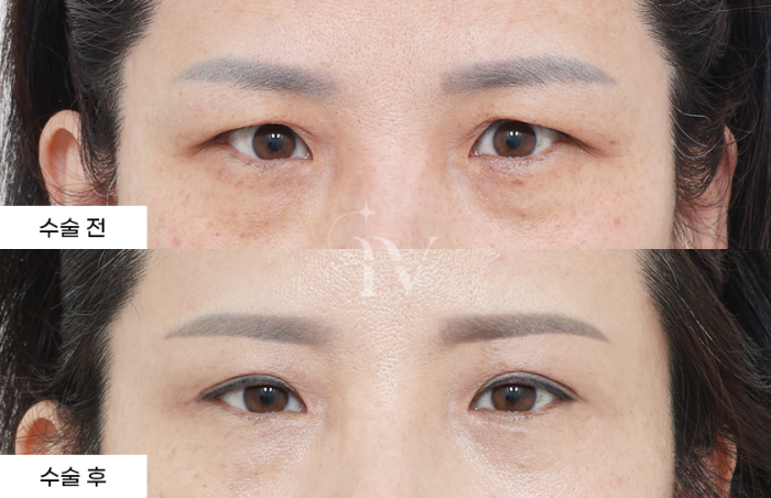 눈썹거상, 상안검