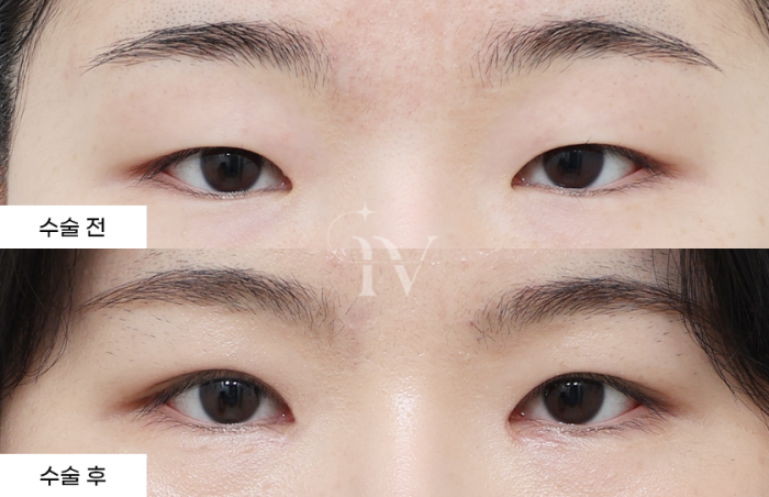 절개 쌍꺼풀, 앞트임