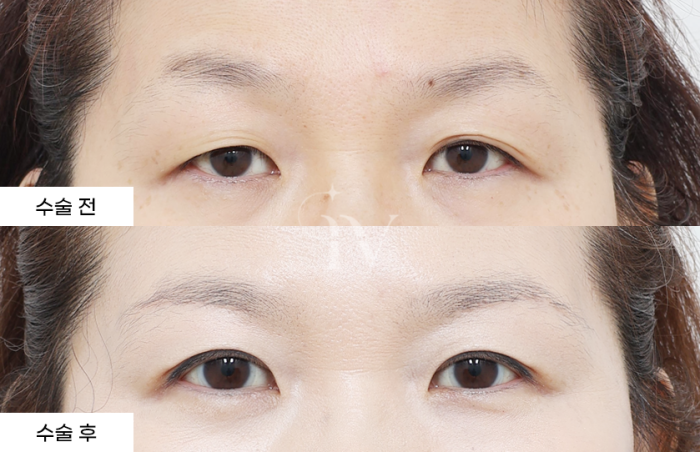 눈썹하거상, 매몰 쌍꺼풀