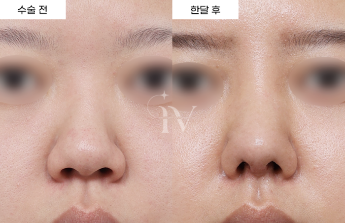 콧대, 코끝, 비중격, 귀연골, 기증늑