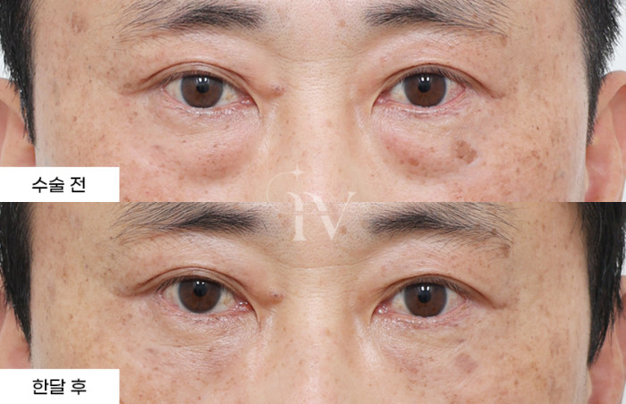 눈밑지방재배치, 눈밑나노지방이식