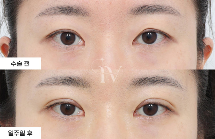 매몰쌍꺼풀(타병원눈재수술)
