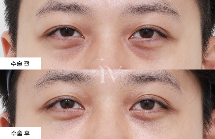 눈밑지방재배치, 나노지방이식