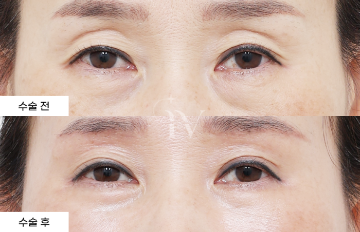 눈썹하거상, 하안검중안부거상
