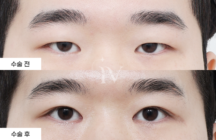 절개 쌍꺼풀, 눈매교정, 앞트임