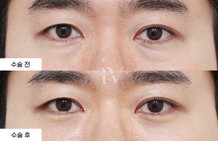 눈밑지방재배치, 나노지방이식