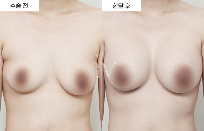 멘토 엑스트라, 부유방 흡입