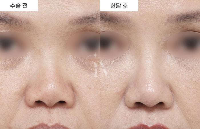 콧대, 코끝, 비중격, 기증늑