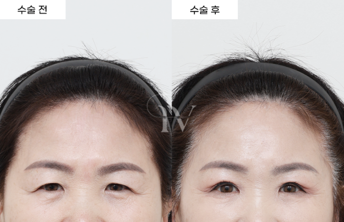 내시경이마거상, 상안검, 하안검중안부거상