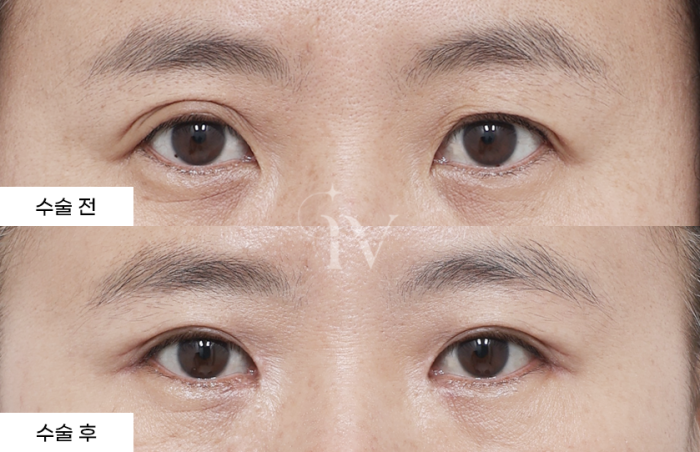 상안검, 앞트임, 듀얼트임