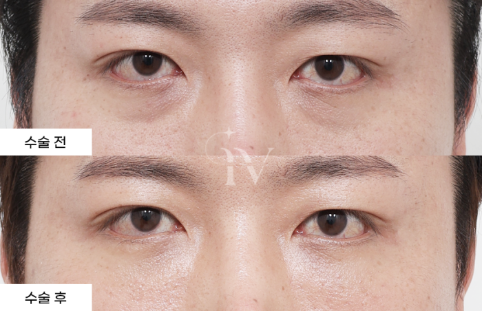 눈밑지방재배치. 나노지방이식