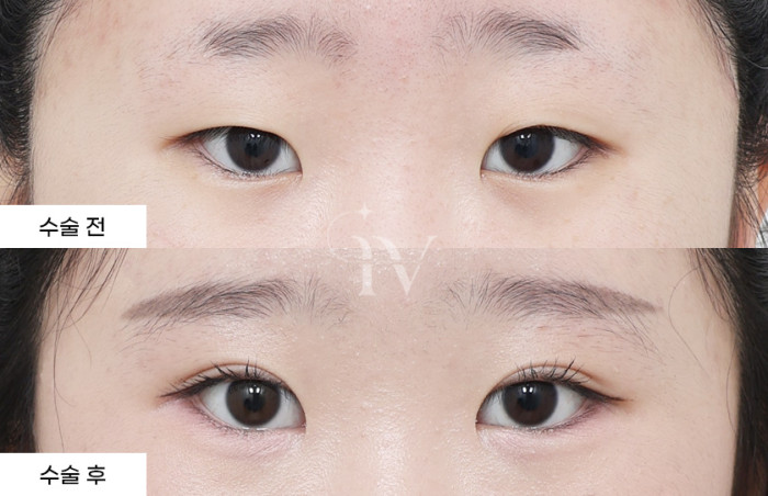 앞트임, 매몰쌍꺼풀