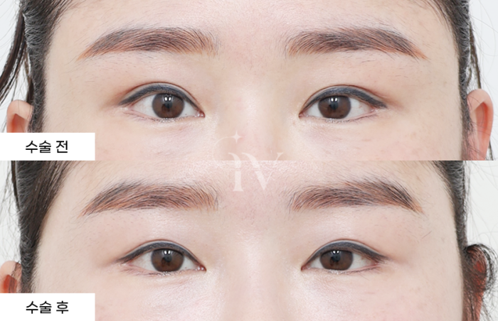 매몰, 눈매교정 (타병원 눈재수술)