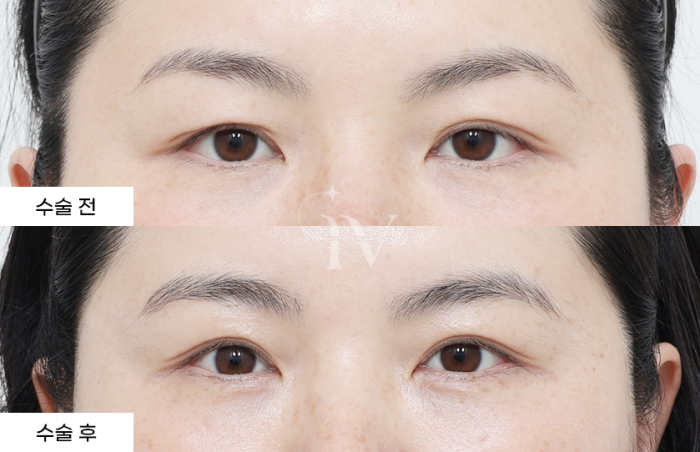 상안검 (타병원 눈재수술)