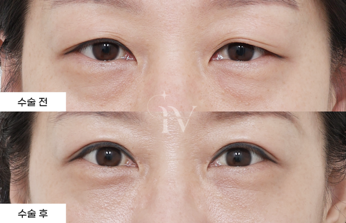 상안검, 눈밑지방재배치, 나노지방이식