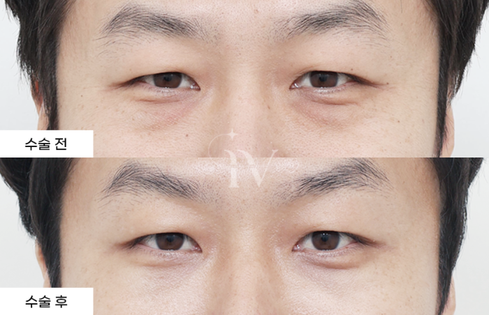 눈밑지방재배치