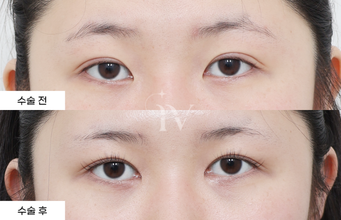 절개 쌍꺼풀, 윗트임