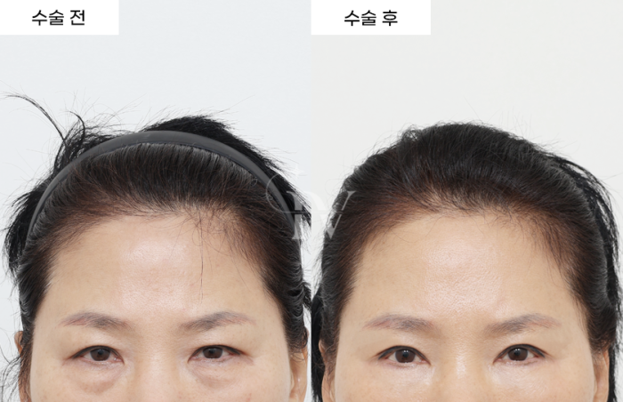 내시경이마거상, 상안검 (타병원 눈재수술), 중안면거상