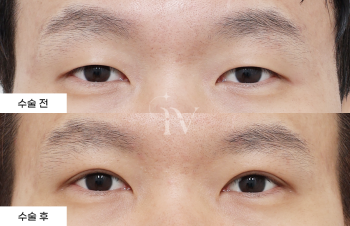 절개 쌍거풀, 눈매교정