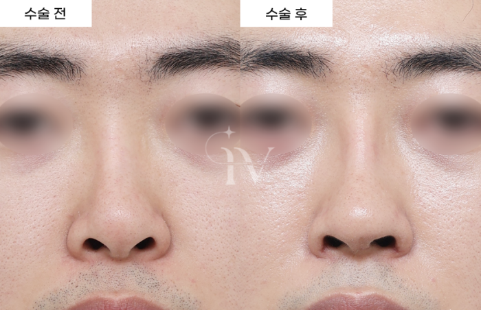 콧대, 코끝, 귀연골, 기증늑 [타병원 코재수술]