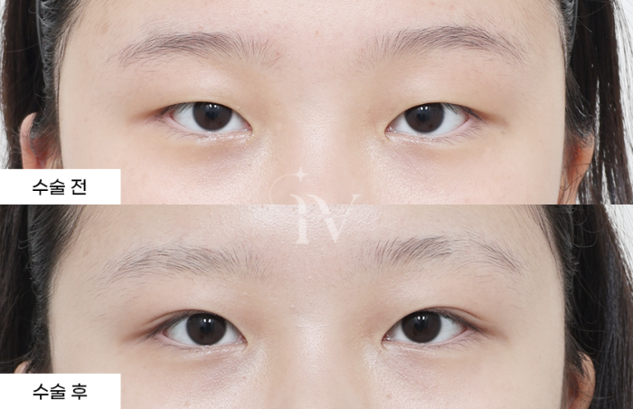 매몰, 눈매교정