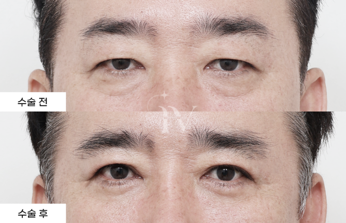 상안검, 하안검, 듀얼트임