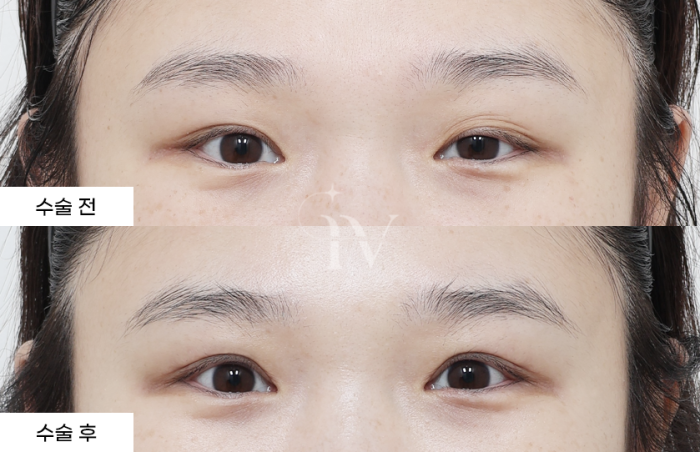 절개 쌍꺼풀, 눈매교정