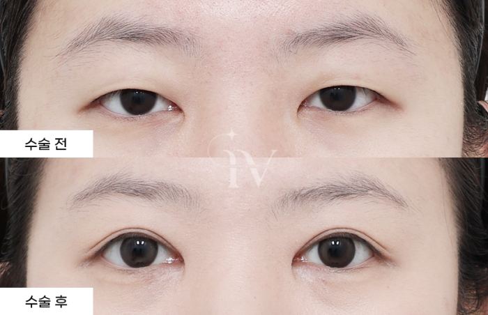 절개 쌍꺼풀, 눈매교정