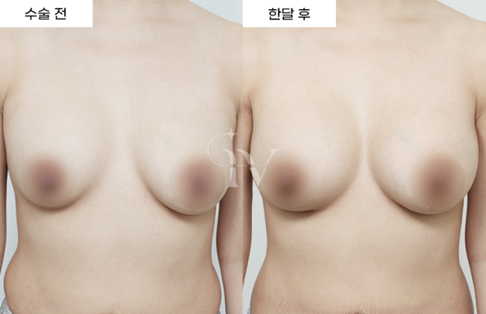 멘토 엑스트라 [타병원 가슴재수술]