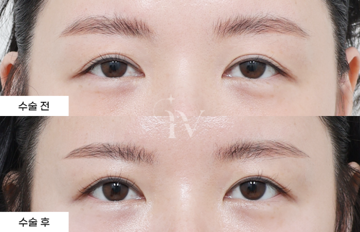 매몰, 눈매교정 (타병원 눈재수술)