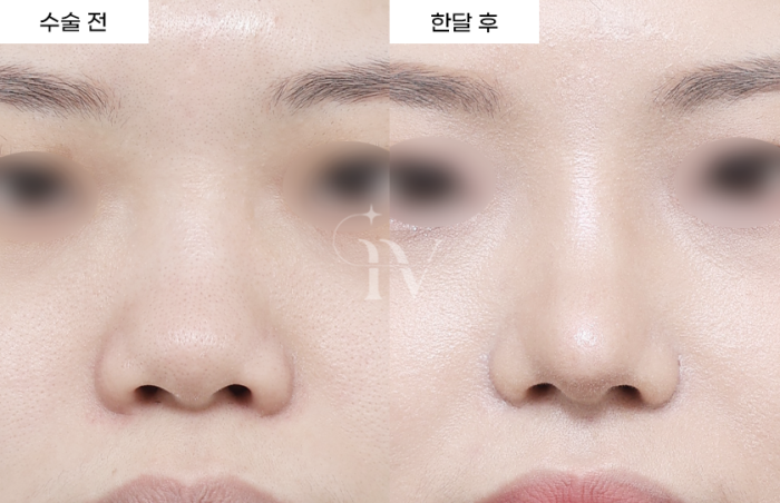 콧대, 코끝, 비중격, 기증늑