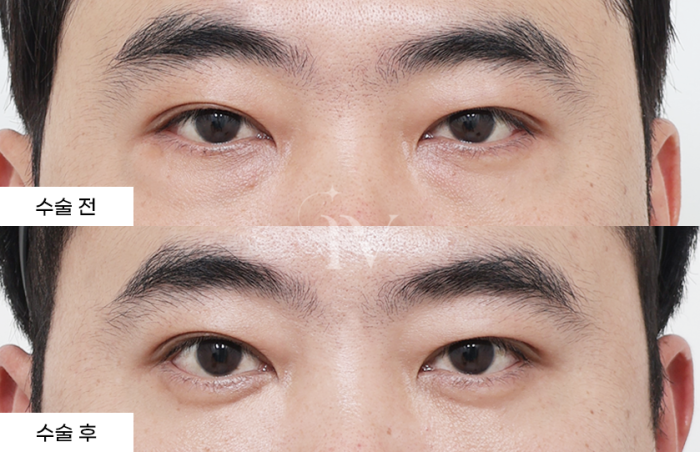 눈밑지방재배치