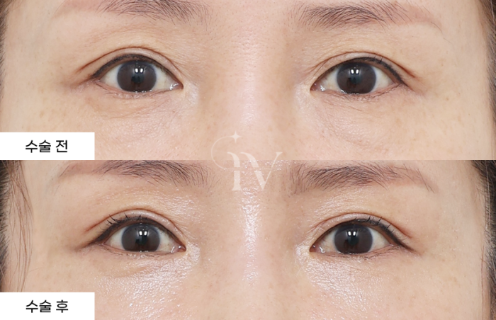 눈밑지방재배치