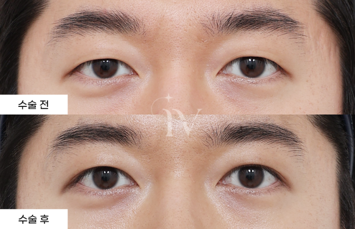 절개 쌍꺼풀, 눈매교정