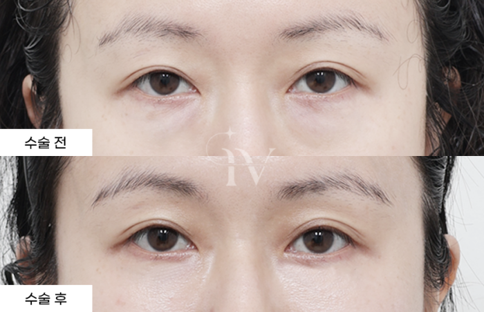 눈밑지방재배치