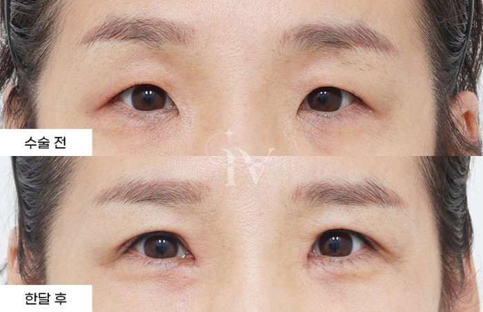 상안검, 앞트임