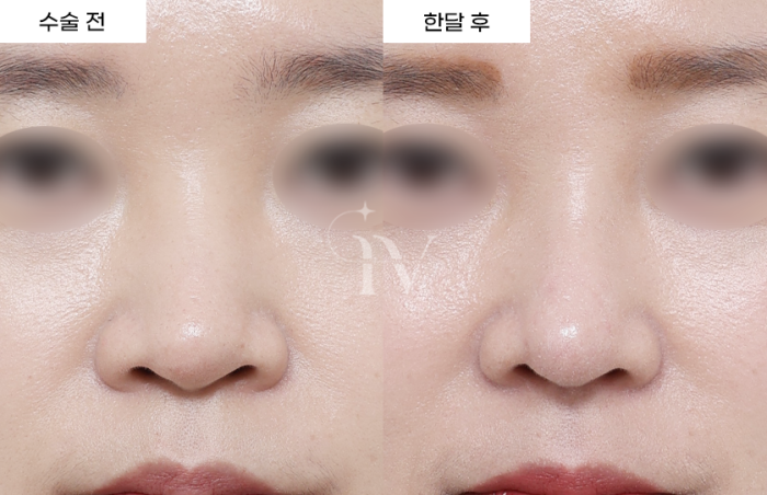 콧대, 코끝, 기증늑, 귀연골 [타병원 코재수술]