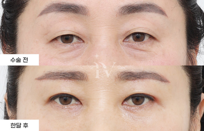 눈썹하거상술, 매몰 쌍꺼풀, 눈밑지방재배치, 눈밑나노지방이식
