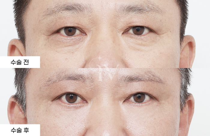 눈썹하거상, 하안검, 눈밑나노지방이식