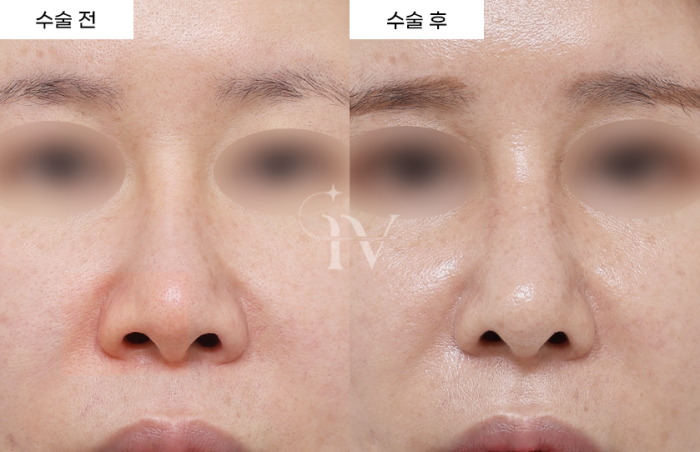 [타병원 코 재수술] 콧대 실리콘 교체, 코끝 기증늑, 귀연골