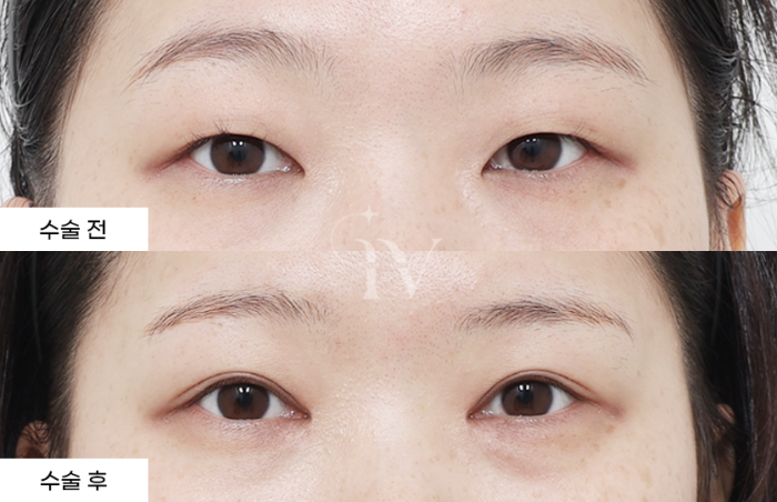 절개쌍꺼풀, 앞트임